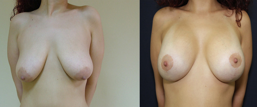 result_breastlifting1