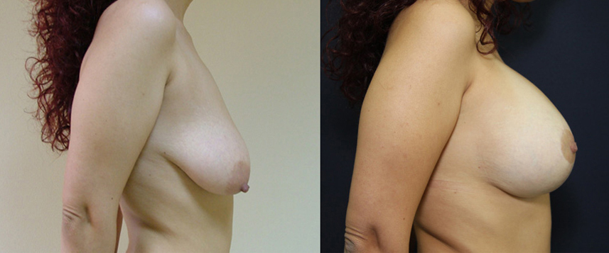 result_breastlifting2