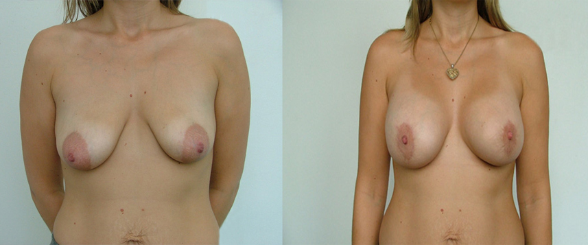result_breastlifting3