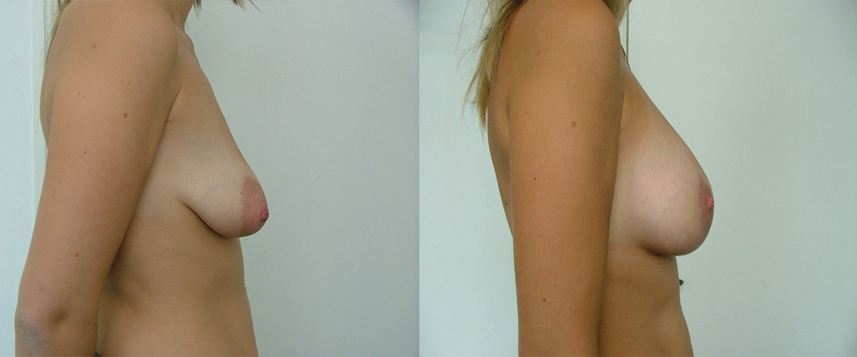 result_breastlifting4