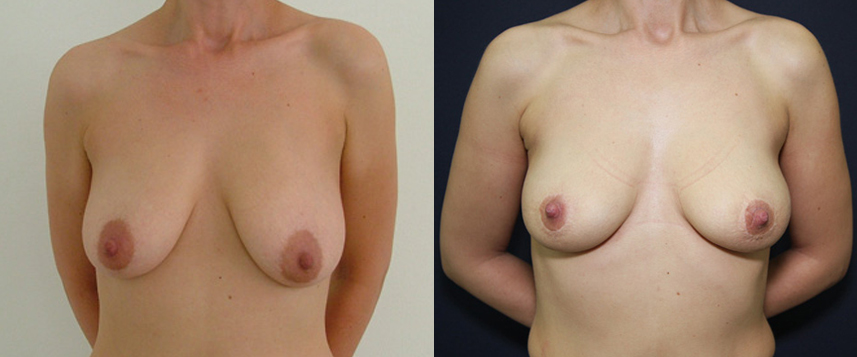 result_breastlifting5