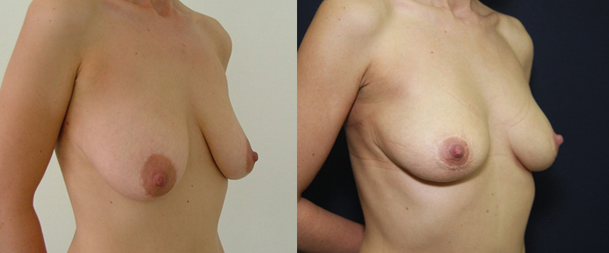 result_breastlifting6