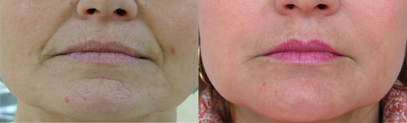 result dermabrasion2