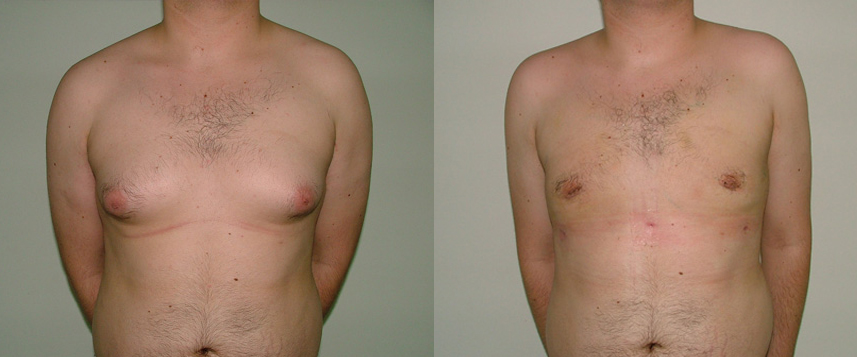 result_gynecomasty1