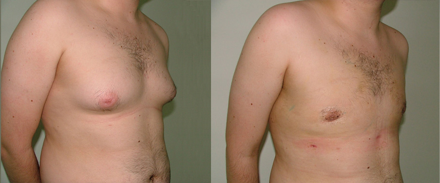result_gynecomasty2