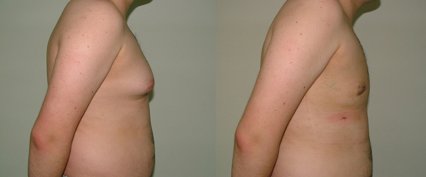 result_gynecomasty3